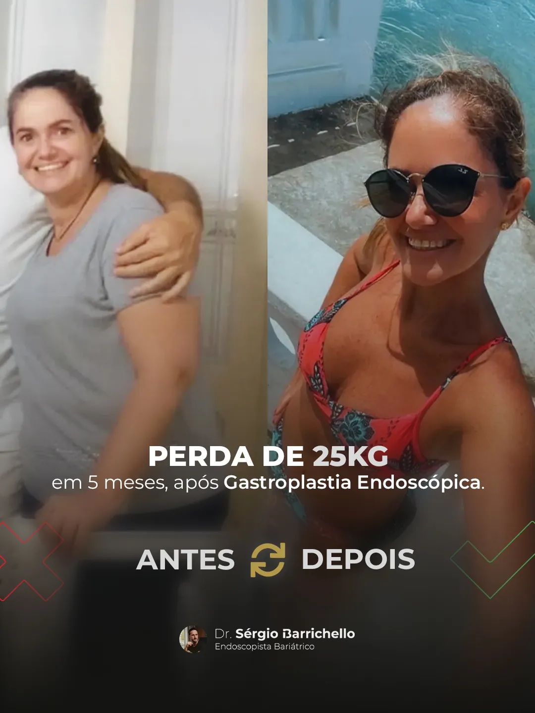 Gastroplastia endoscópica: sutura interna do estômago