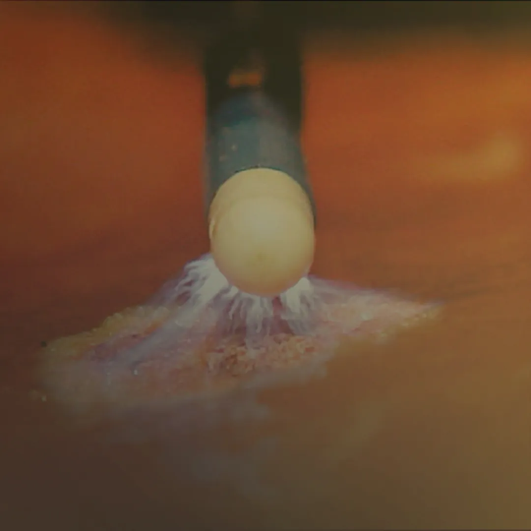 Plasma de argônio aplicado por endoscopia
